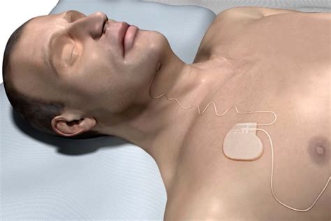 Keck Medicine of USC offers FDA-approved sleep apnea implant - USC Today