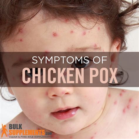 Chickenpox