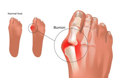 Orthobliss.ca