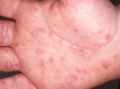 Amoxicillin Rash Hands And Feet