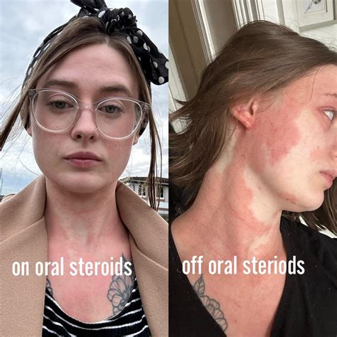Mystery widespread rash that is so painful and itchy I am on antidepressants - please help. : r ...