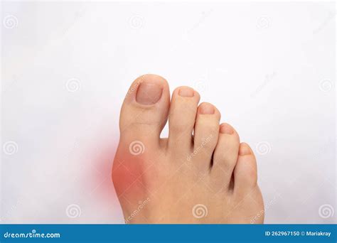 Foot Disease Rheumatism and Gout. Painful Gout Inflammation on Big Toe Joint with Red Spot Stock ...