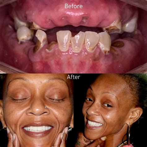 Dentures | Smile Institute - Glades Rd Suite E-6, Boca Raton