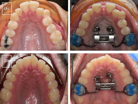 Palate Expander Before And After