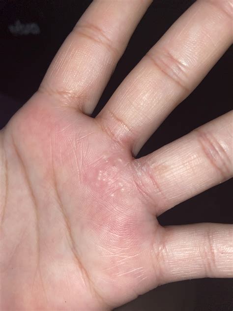 Herpetic Whitlow On Foot Best Sale | emergencydentistry.com