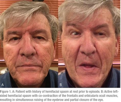 Managing Eyelid and Facial Spasms | Facial nerve, Facial, Medication management