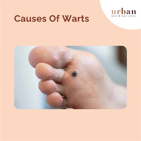 Warts Types, Causes, Symptoms & Treatment