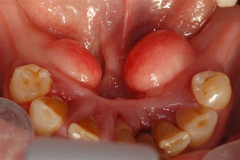 Bilateral Torus Mandibularis