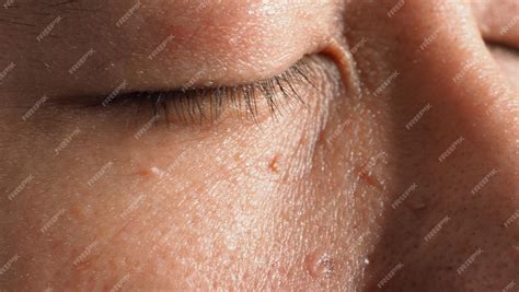 Wart Removal On Face