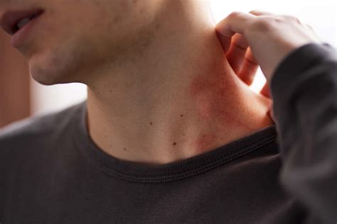 Can Stress Cause Eczema Flare Ups? – East West Dermatology