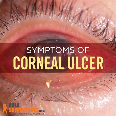 Corneal Ulcer