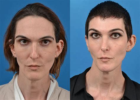 Face Feminization Surgery Before And After