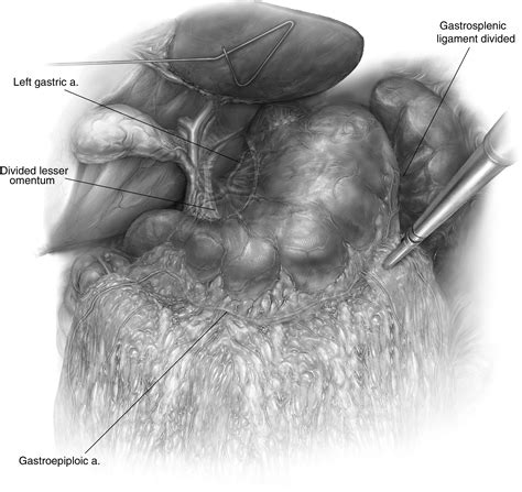 Technique of Minimally Invasive Ivor Lewis Esophagectomy - Operative Techniques in Thoracic and ...