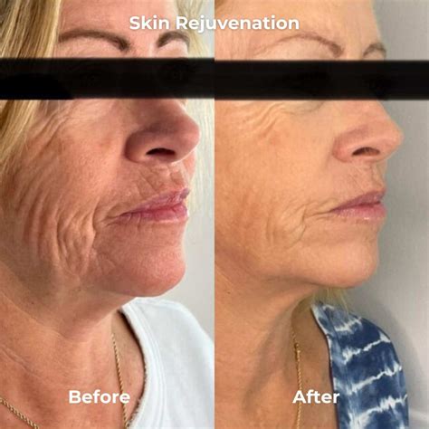 Radiofrequency Microneedling Before and After Photos - House of Beauty | Top Rated