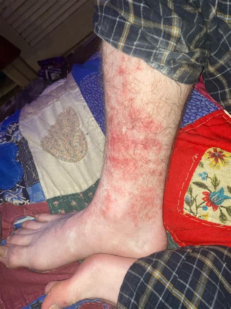 Should i go to Er? : r/AskDoctorSmeeee