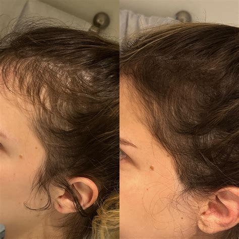 Alternatives to minoxidil? : r/FemaleHairLoss