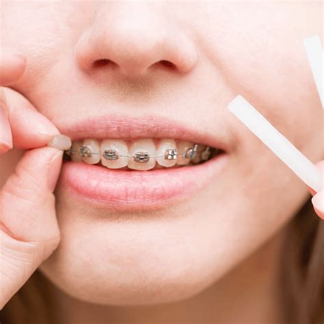 How to Use Orthodontic Wax: A Complete Guide for Braces Comfort