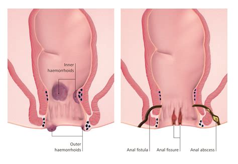 Bone Fissure Symptoms