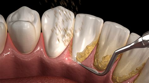 What Is Tartar And How Can I Prevent It? - Affinity Dental