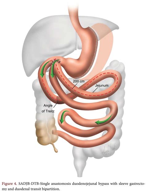Scientific Research Publishing on LinkedIn: #obesity #duodenal_switch #bariatric_surgery # ...