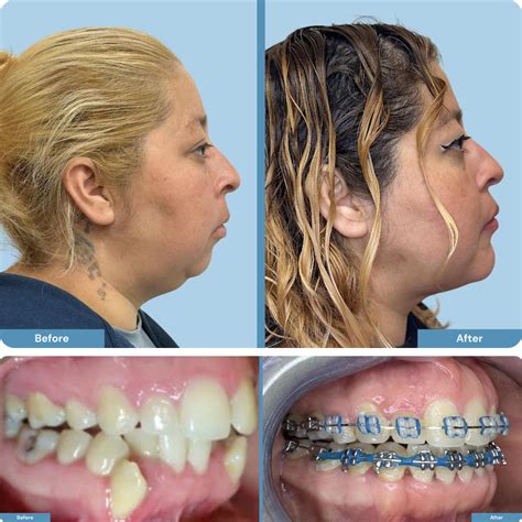 Orthognathic Jaw Surgery | Staten Island Oral Surgery