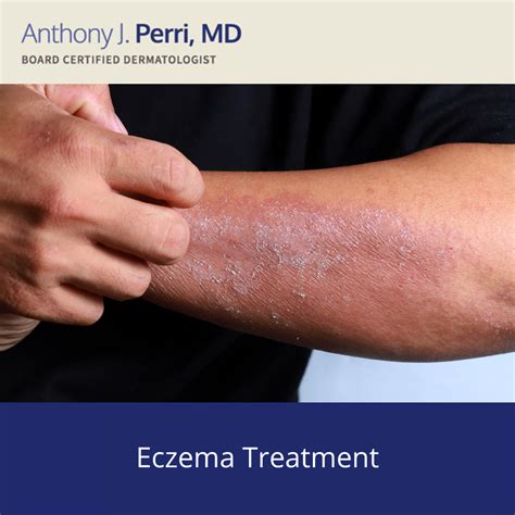 Eczema - Overview | Perri Dermatology