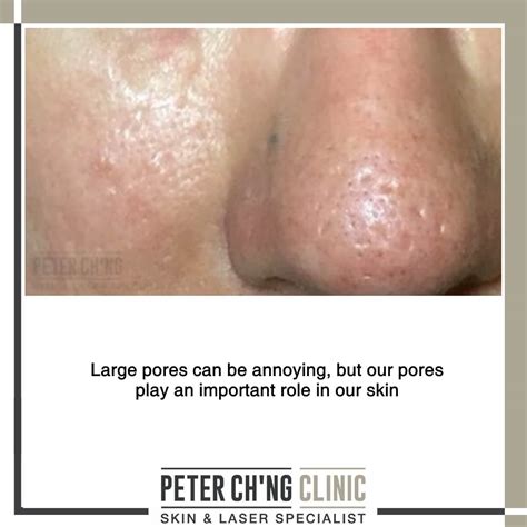 5 Things You Misunderstood About Your Large Pores | Peter Ch'ng Skin Specialist - KL, Malaysia