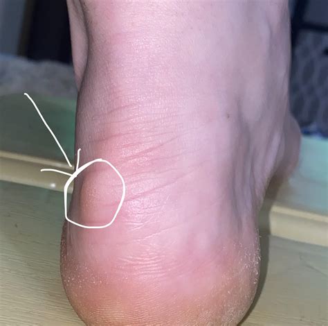 Knot on the back left of right foot, hurts to wear shoes : r/Podiatry
