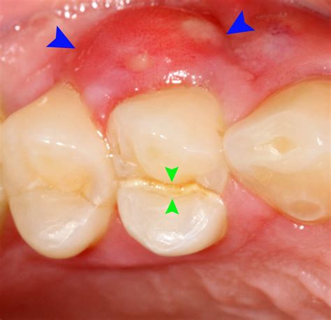 Abscess Tooth And Gum at Kenneth Allen blog