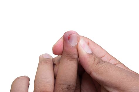 Ingrown Fingernail Treatment: At-Home and When to See a Healthcare Provider