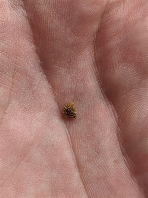 Passing Kidney Stones Passed My First Stone Ever With The Jump And