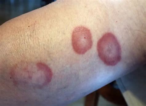 Granuloma Annulare Treatment