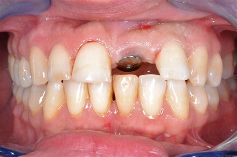 Single Tooth Implants - Fernlea Dental Implant Centre