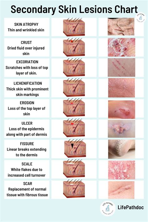 Skin Lesions: Types with Chart, Pictures, Causes, Treatment
