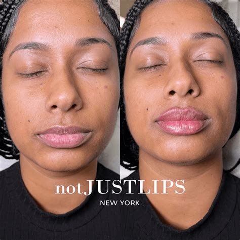 Lip Augmentation Complete Guide for 2026 | belliata.com