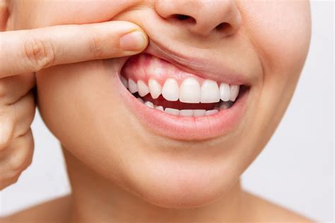 Receding Gums: Symptoms, Consequences, and Remedies – Smile Dental Partners