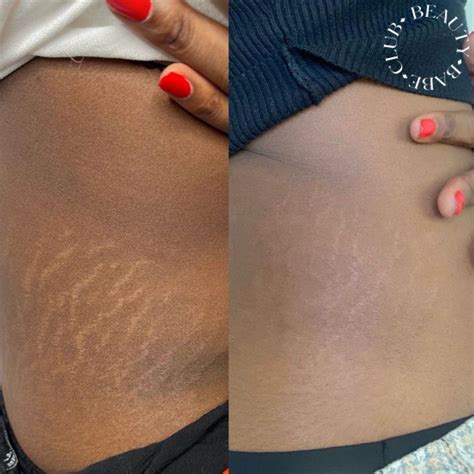 Transform Lives with Inkless Stretch Mark Removal Training