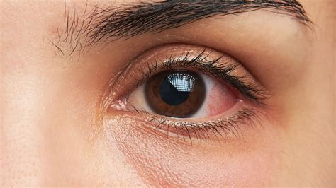 Fabulous Info About How To Reduce Swelling Around The Eye - Pricelunch34