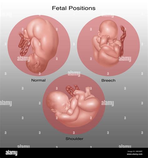 Lateral Recumbent Fetal Position
