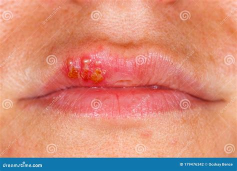 Oral Herpes Inside Lips