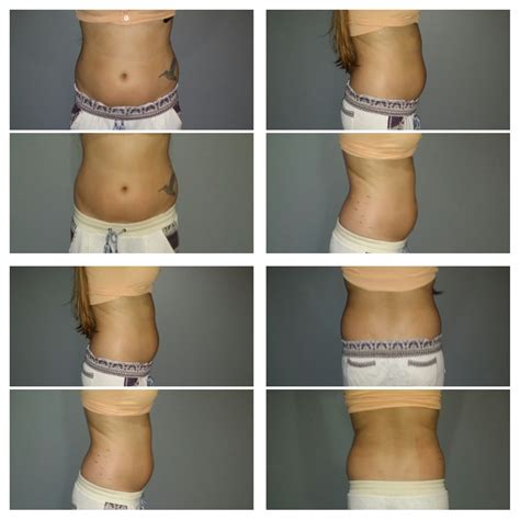 spa810 - Strawberry Laser Lipo Treatment | Best Self Atlanta