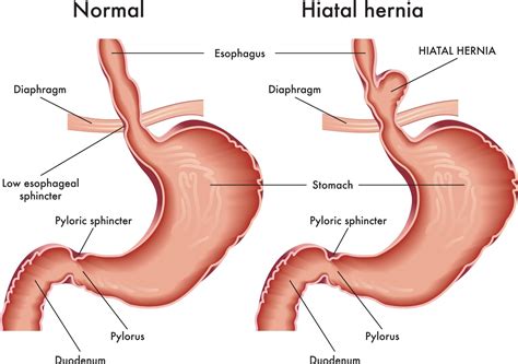 Hiatal Hernia Surgery | North Carolina Specialty Hospital