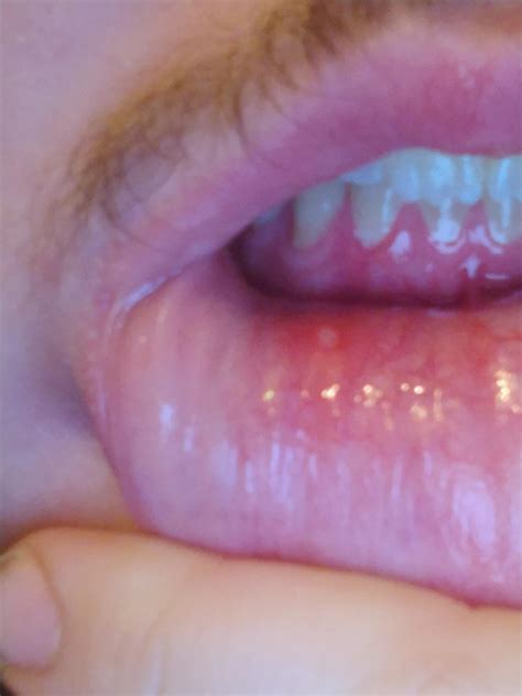 Hello cut this white bump be mouth cancer it hurts I'm really scared right now : r/medical_advice