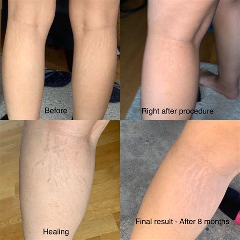 Famous stretch mark camouflage - not worth it, girl was trained in ...