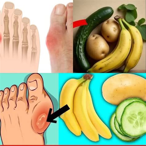 8 Natural Ways to Lower Uric Acid and Prevent Gout