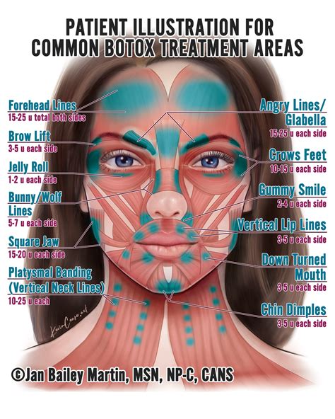 Botox Injection Sites