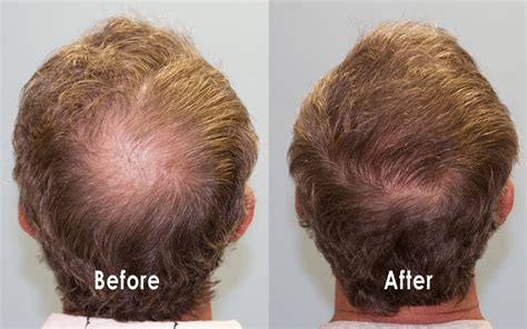 Crown (Vertex) Hair Restoration - Carolina Hair Surgery