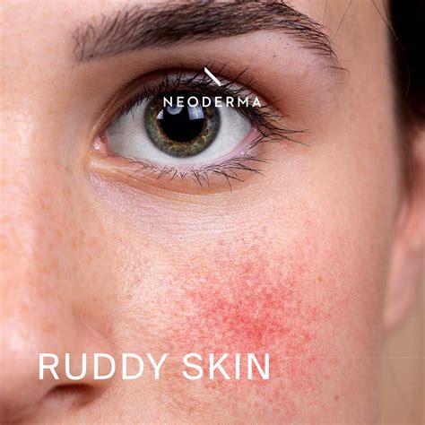 Ruddy Skin Calming Products | NEODERMA