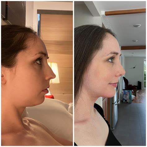 1 month post op. Chin implant, neck lift and nose job with Dr Yirae Ort - $25k total. I don’t ...