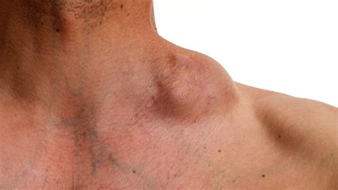 Cáncer linfático: Conoce los tipos, síntomas y tratamientos